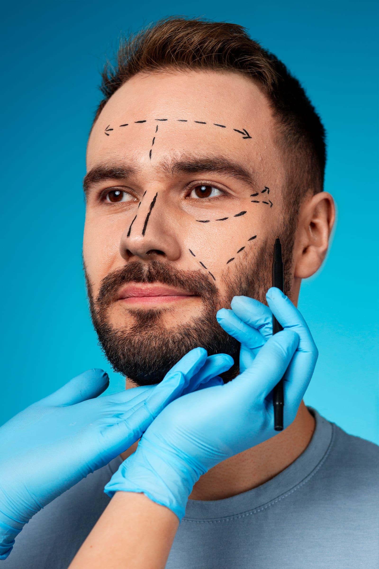 Illustrative facelift consultation showing facial treatment planning markings
